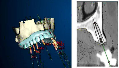 Impianti e protesi progettati al computer fig 5